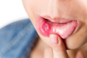 Loét miệng có thể là dấu hiệu HIV