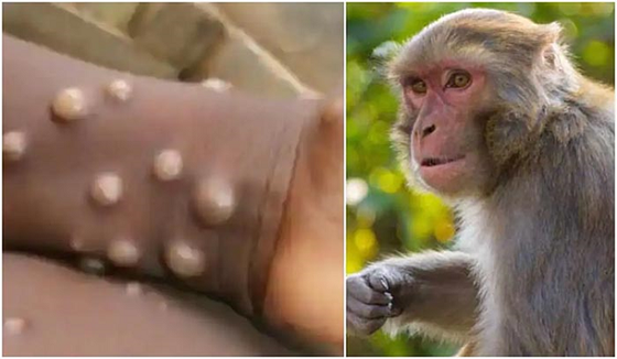 Vietnam likely to record more new monkeypox cases: Ministry